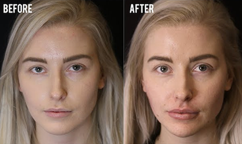 cheek filler symmetry contouring before after mississauga oakville toronto